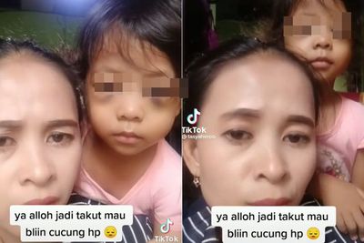 Mata Bocah Perempuan Ini Bengkak Akibat Sering Main HP, Ibunya Peringatkan Para Ortu