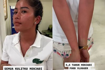 Food Vlogger Farida Nurhan Keracunan Makanan, Seluruh Tubuhnya Memerah