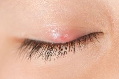 5 Obat Mata Bintitan dari Bahan Alami yang Terbukti Ampuh