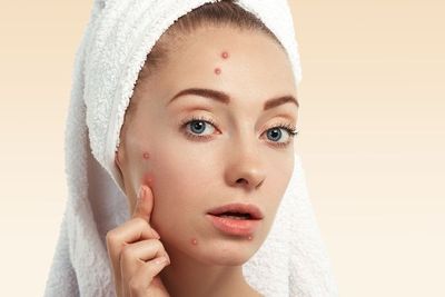 Jerawat Stres Bikin Pusing Tujuh Keliling: Simak Ciri-cirinya!
