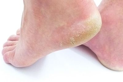 5 Obat Kaki Pecah-Pecah Alami yang Terbukti Paling Ampuh