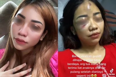 Wajah Perempuan Cantik Ini Babak Belur karena Jadi Korban Kekerasan Kekasihnya