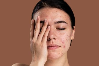 Punya Acne Scars, Begini Atasi Wajah Bopeng Akibat Bekas Jerawat