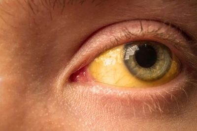 Mengenal Penyakit Kuning, Salah Satu Gejala Hepatitis