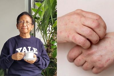 Sejarah AIDS di Indonesia, Prof Zubairi Djoerban Penemu Pertama Kali Tahun 1983
