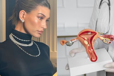 Hailey Baldwin Ungkap Dirinya Idap Kista Ovarium Sebesar Apel, Ini Penyebabnya!