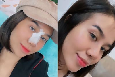Mayang Pamer Hasil Operasi Hidung Rp50 Juta: Aura Artisnya Belum Dapet