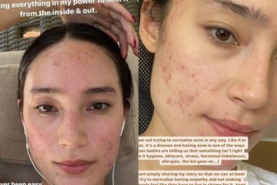 Tatjana Saphira Sengaja Tunjukkan Bare Face, Wajah Jerawatan Berani Tampil Apa Adanya
