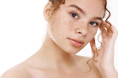 Apa Penyebab dan Pencegahan Melasma, Bercak Coklat di Wajah? Ini Penjelasannya!