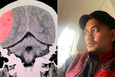 Dialami Indra Bekti, Dokter Ungkap Alasan Terjadinya Pendarahan Otak