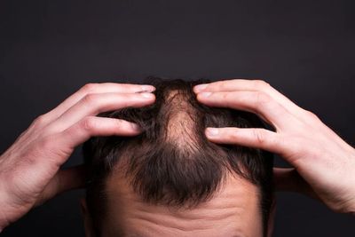 Dear Cowok-cowok, Kebanyakan Minuman Manis Bisa Picu Rambut Botak Loh!