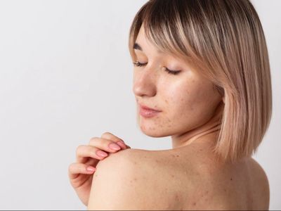 6 Tips Atasi Jerawat Punggung Secara Alami dan Permanen