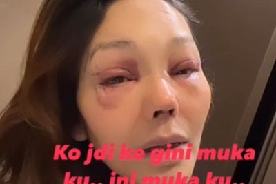 Bunda Corla Pamer Wajah Bengap Bekas Operasi, Netizen Nangis: Aslinya Lebih Menarik