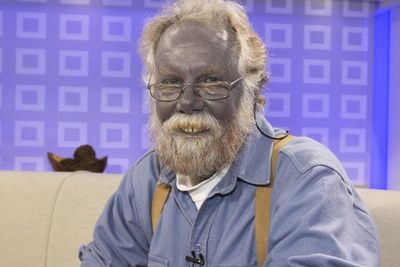 Kisah Paul Karason, Pria yang Dijuluki Papa Smurf karena Kulitnya Biru akibat Obat Diet