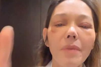 Mata Bunda Corla Bengap Parah Kayak Abis Ditonjok, Terkuak Penyebabnya!