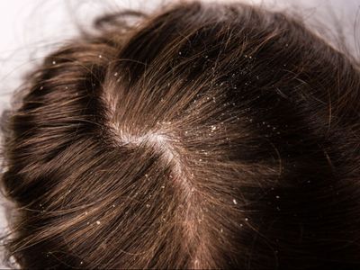 Serpihan di Kulit Kepala yang Dikira Ketombe Bisa Jadi Psoriasis, Apa Perbedaannya?