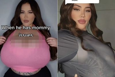 Duh! Payudara Wanita Ini Membesar karena Kondisi Langka sampai Ganggu Kesehatan Mental