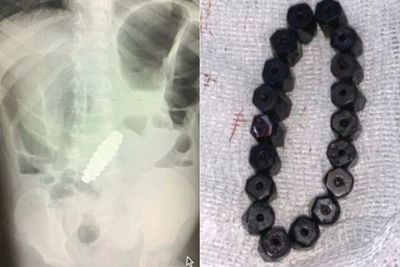 Ngeri! Ada Gelang Magnet di Perut Bocah 4 Tahun Ini, Dokter sampai 2 Kali Operasi