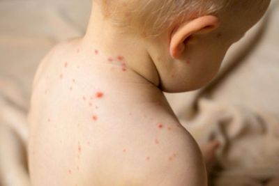 Kasus Campak Meningkat, Dokter Sarankan untuk Konsumsi Vitamin A Dosis Tinggi
