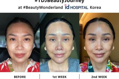 Transformasi Wajah Titi DJ Usai Operasi Anti Aging di Korea, Jadi Makin Awet Muda