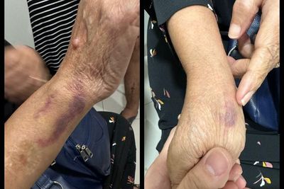 Viral, Pergelangan Tangan Nenek 69 Tahun Ini Memar Kena Lato-Lato usai Diajari Cucu