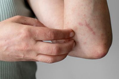 5 Rekomendasi Sabun Mandi untuk Penderita Kulit Eksim