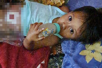 Sedihnya Almeera, Balita yang Ditinggalkan Orang Tuanya karena Menderita Penyakit Langka