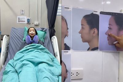 Lucinta Luna Operasi Plastik Lagi karena Dihujat Mirip Pinokio, Begini Penampakan Hasilnya