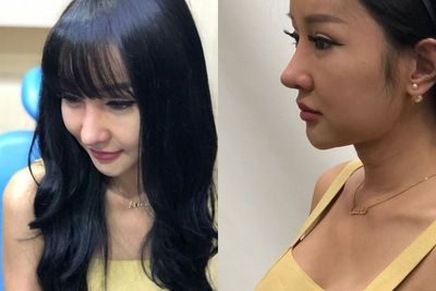 Lucinta Luna Lepas Perban, Pamer Hidung Baru Usai Oplas di Thailand: Batangnya Kegedean