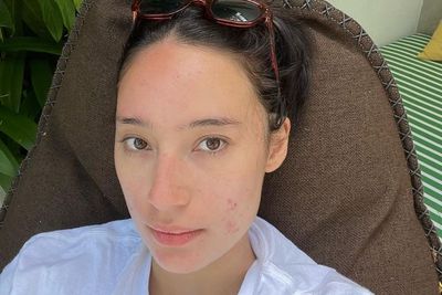Tatjana Saphira Kembali Pamer Wajah Berjerawat, Butuh 10 Tahun untuk Sembuh