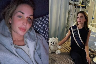 Miss Belgia 2022 Kecelakaan, Bekas Luka di Area Mata Nodai Wajah si Ratu Kecantikan