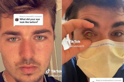 Mata Pria Ini Buta Gara-gara Lupa Lepas Softlens pas Tidur, Matanya Digerogoti Parasit