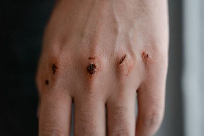 6 Obat Penghilang Bekas Luka Paling Ampuh, Aman dan Alami!