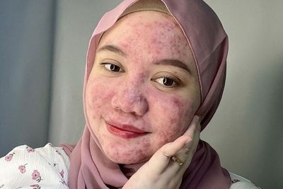 Miliki Muka yang Dipenuhi Jerawat, Wanita Ini Ungkap Kisah Harunya Karena Banyak Dihujat