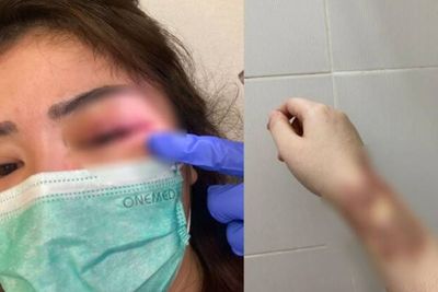 Sepupu Calon Istri Fritz Hutapea Jadi Korban KDRT hingga Memar di Wajah dan Tangan