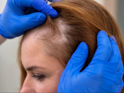 6 Penyebab Rambut Rontok Hebat Sampai Bikin Botak, Stres Salah Satunya!