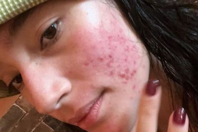 Dikritik karena Wajahnya Jerawatan Parah, BB Tatjana Saphira Turun: Rasanya Capek, Sedih