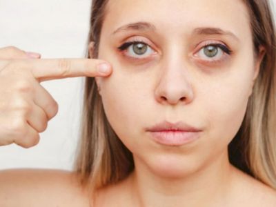 6 Bahan Rumahan Ini Bisa Kurangi Lingkaran Hitam di Mata, Apa Saja?