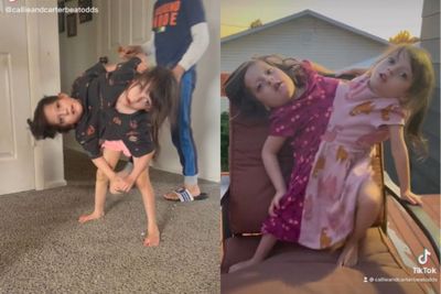 Kisah Heroik Ibu yang Punya Anak Kembar Siam, Sempat Mau Digugurin Dokter Tapi Ia Tolak