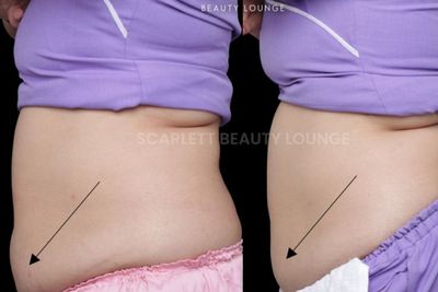 Treatment Cool Shaping di Scarlett Beauty Lounge, Bisa Bikin Bagian Tubuh Lebih Ideal