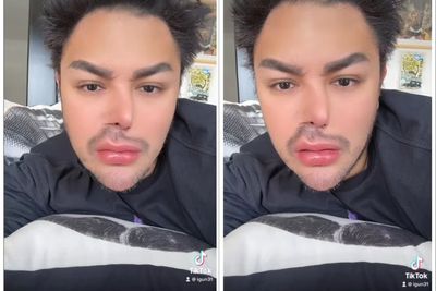 Ivan Gunawan Pamer Bentuk Hidung yang Tiba-tiba Penyok, Buat Heboh dan Panik