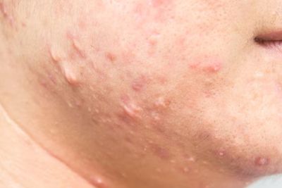 Penyebab dan Cara Mengatasi Jerawat di Leher, Simak Kata Ahli Dermatologi