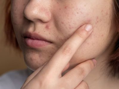 Ini 6 Kesalahan dalam Tidur yang Bisa Sebabkan Jerawat, Jangan Abai Ya!