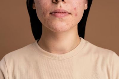 Kulit Sensitif Harus Hati-hati Pilih Skincare untuk Jerawat, Ini Tipsnya
