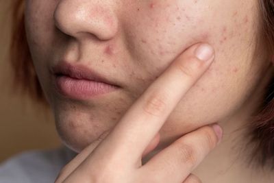 Dokter kecantikan Beberkan Gejala Jerawat yang Perlu Ditangani Medis, Apa Saja?