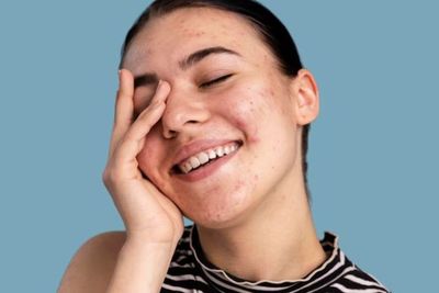 Catat! Tips Memilih Produk Perawatan Jerawat yang Aman untuk Kulit Sensitif