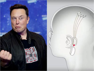 Begini Kondisi Manusia yang Otaknya Ditanami Chip oleh Elon Musk