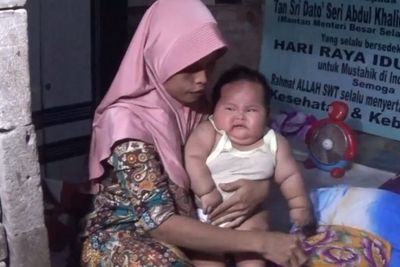 Bayi Obesitas di Bekasi Gak Cuma Alami Gangguan Saraf, Dicurigai Ada Cairan di Otak