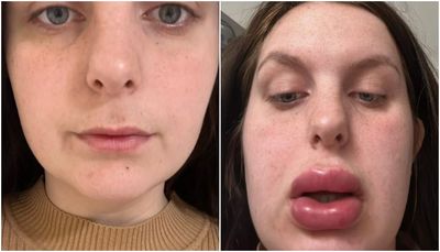 Curhat Wanita Nyesal Lakukan Filler Bibir Hadiah Undian, Niat Mau Seksi Malah Jadi Dower!