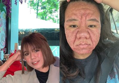 Viral! Curhatan Ibu Hamil yang Wajahnya Berubah Drastis Akibat Hormon, Bikin Dirinya Insecure